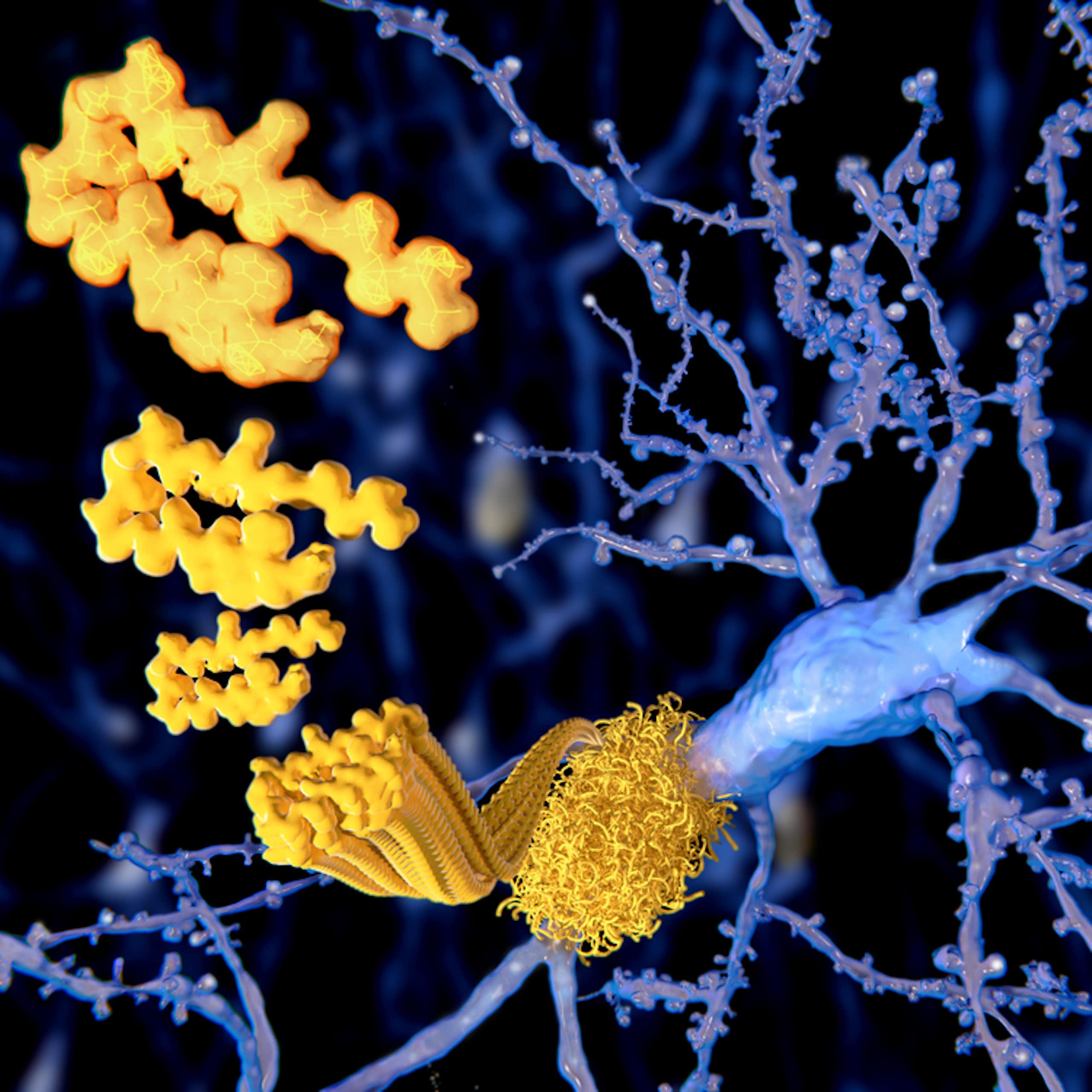 plaques amyloïdes agglutinées sur les neurones