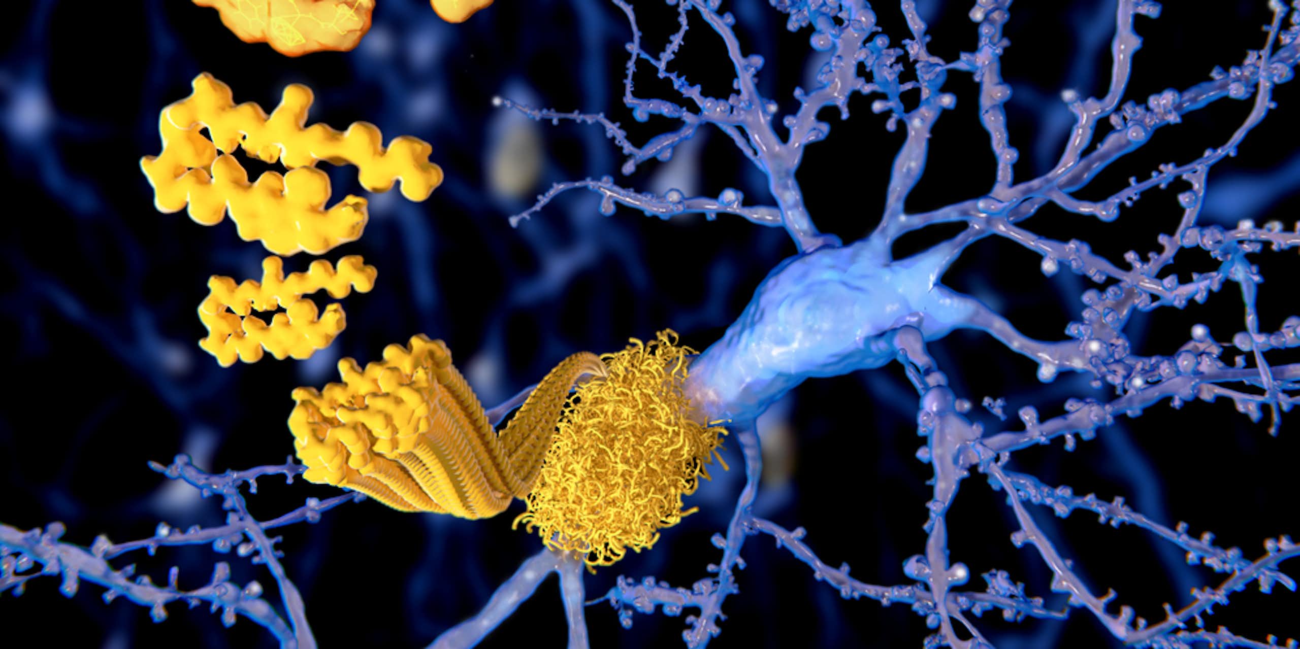 plaques amyloïdes agglutinées sur les neurones