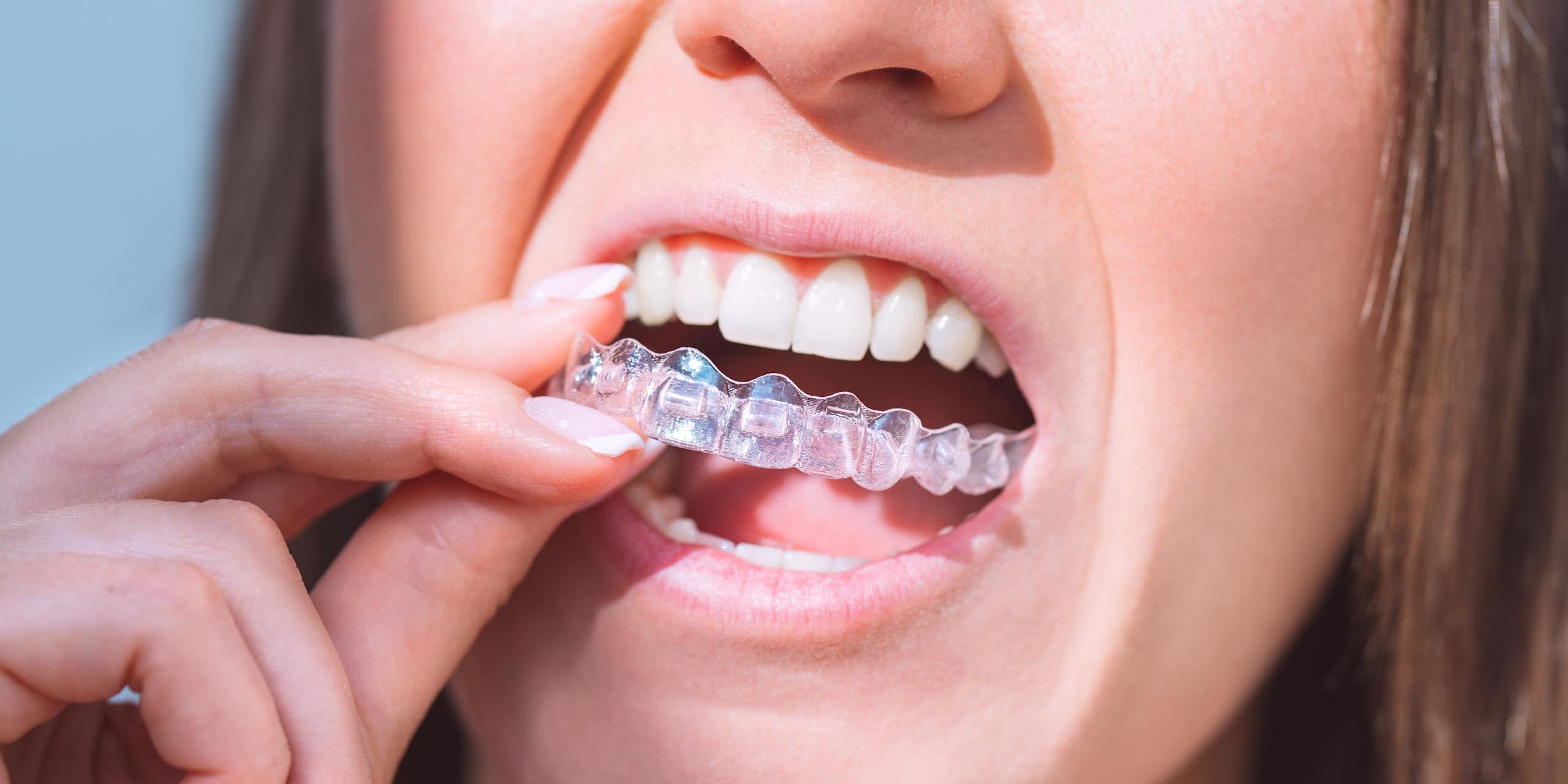 ¿Qué pasa con los alineadores dentales transparentes?