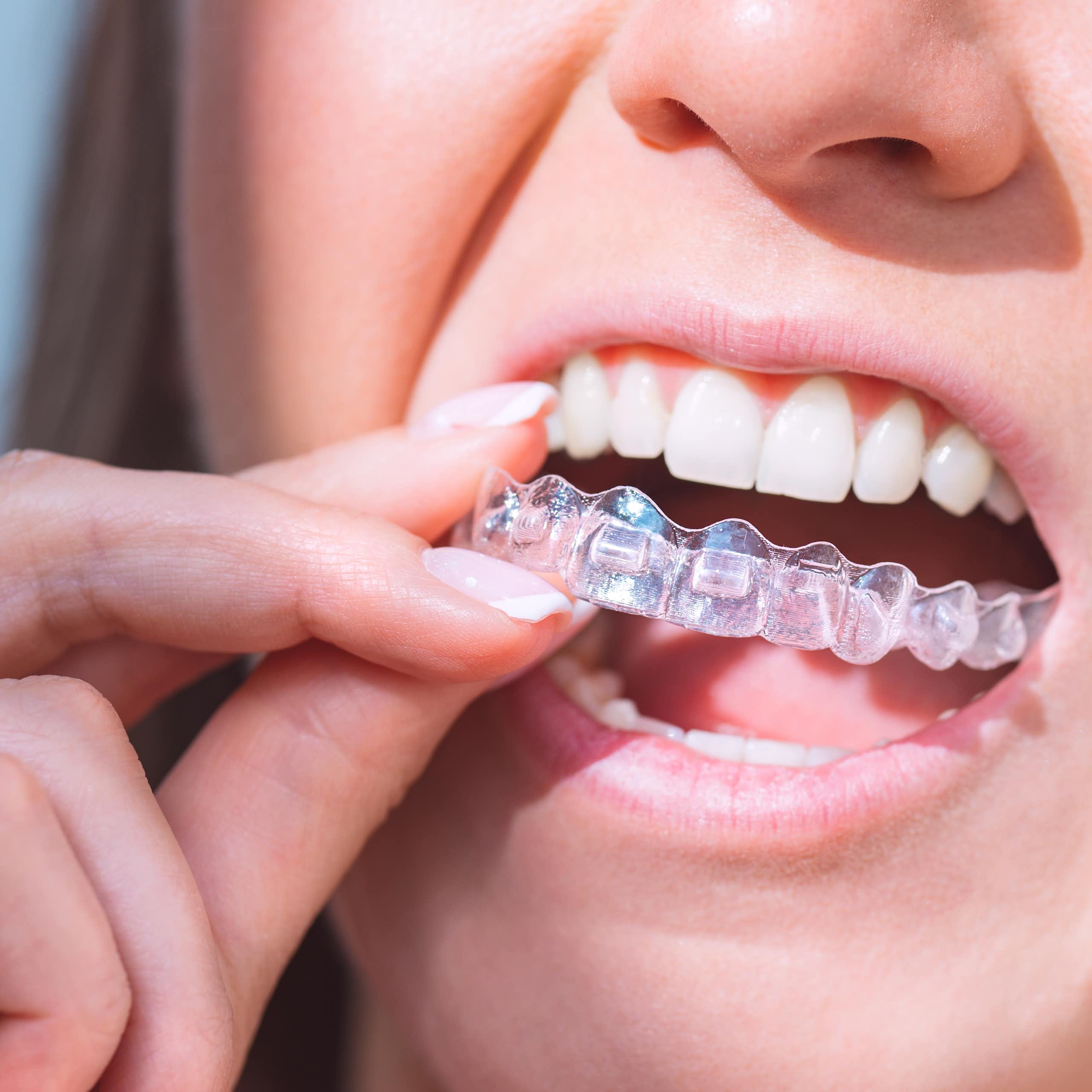 ¿Qué pasa con los alineadores dentales transparentes?